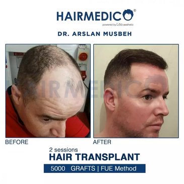 Slider image (3) Hairmedico